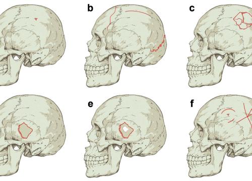   Tipos de fracturas en función de su morfología recogidas en el estudio/Daniel Rodríguez Iglesias