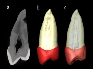 Premolar de Sima de los Huesos: a Premolar de Sima de los Huesos: a